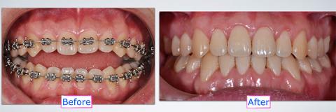 Before and After Braces